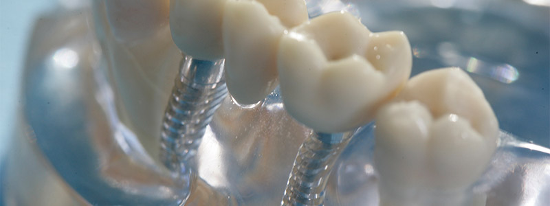 Zahnimplantate, Zahnarztpraxis Coesfeld